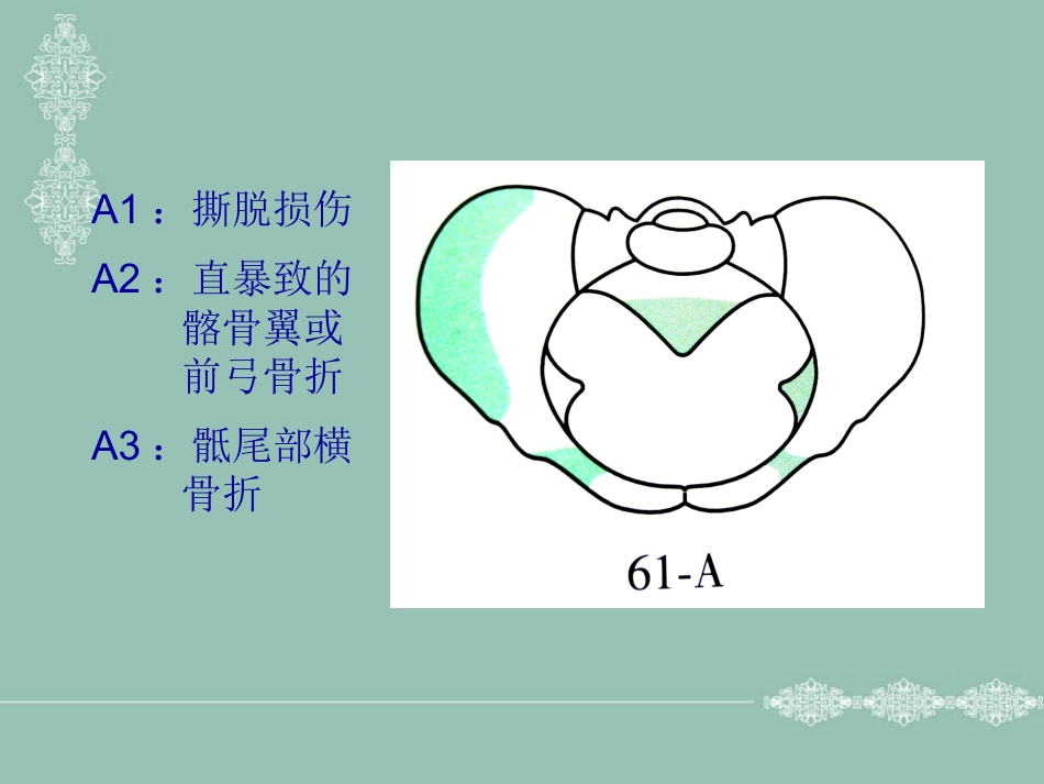 骨盆 髋臼骨折的分型_第4页