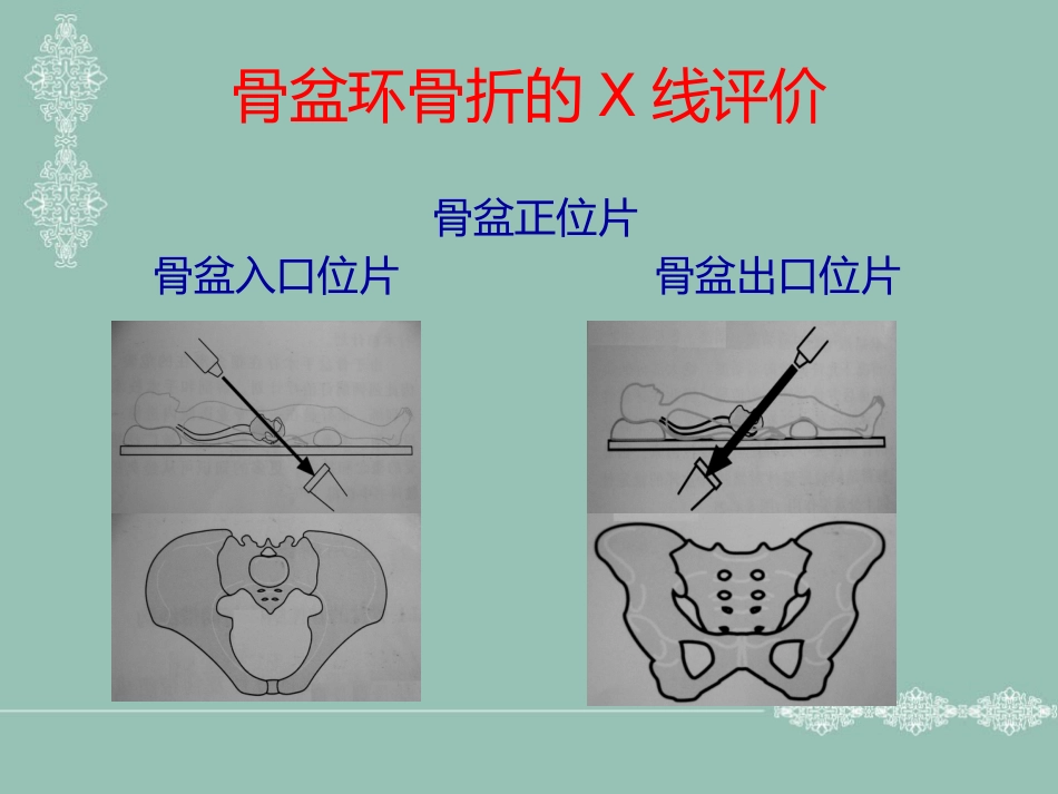骨盆 髋臼骨折的分型_第9页