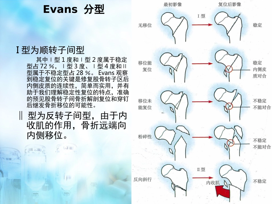股骨粗隆间骨折股骨转子间骨折_第12页