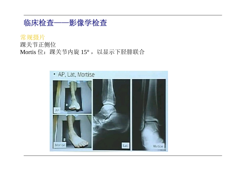 踝关节 骨折_第12页