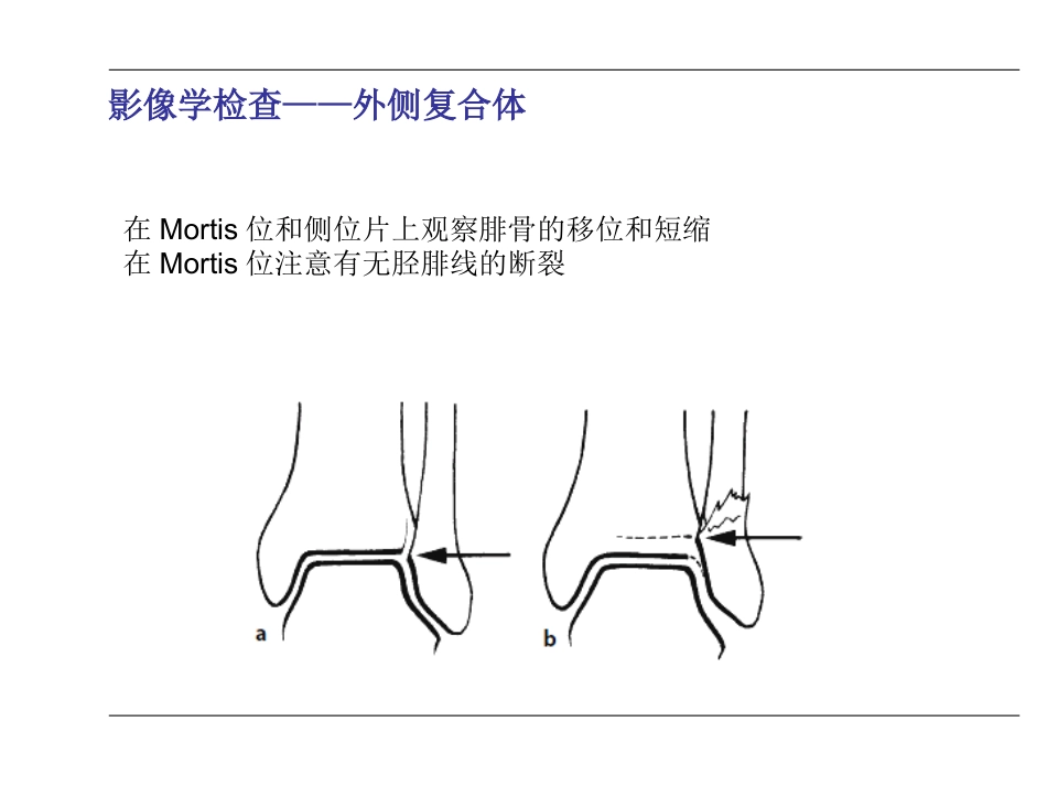 踝关节 骨折_第13页