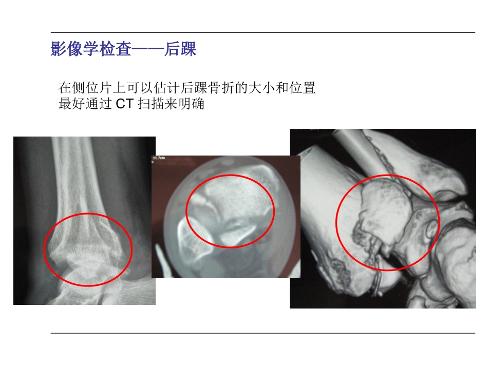 踝关节 骨折_第15页