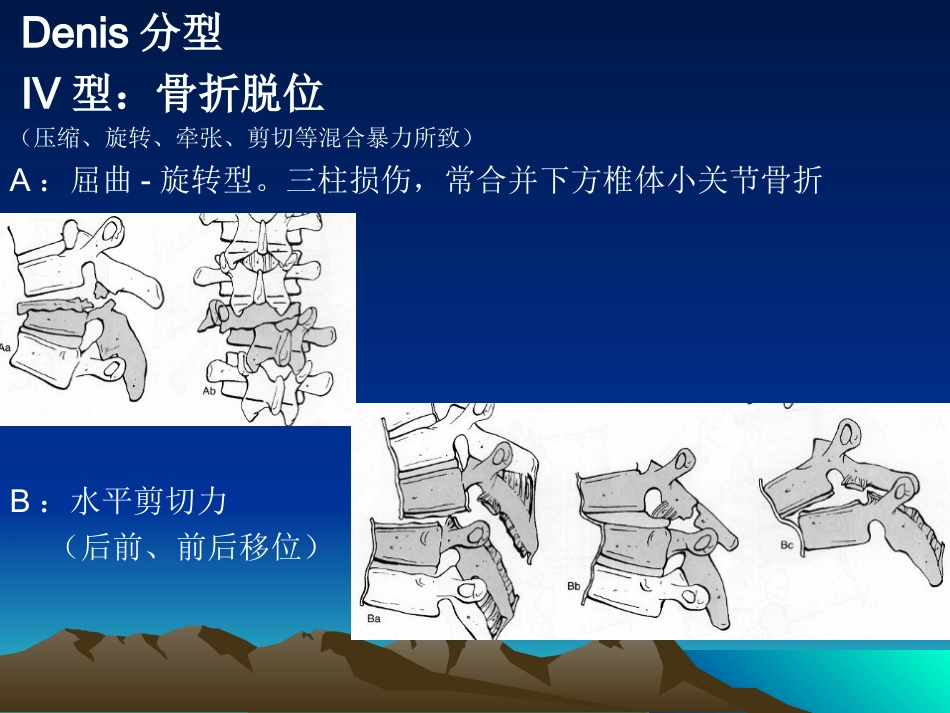脊柱骨折 常用分型及治疗原则_第11页