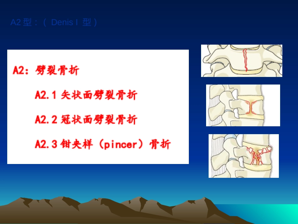 脊柱骨折 常用分型及治疗原则_第15页