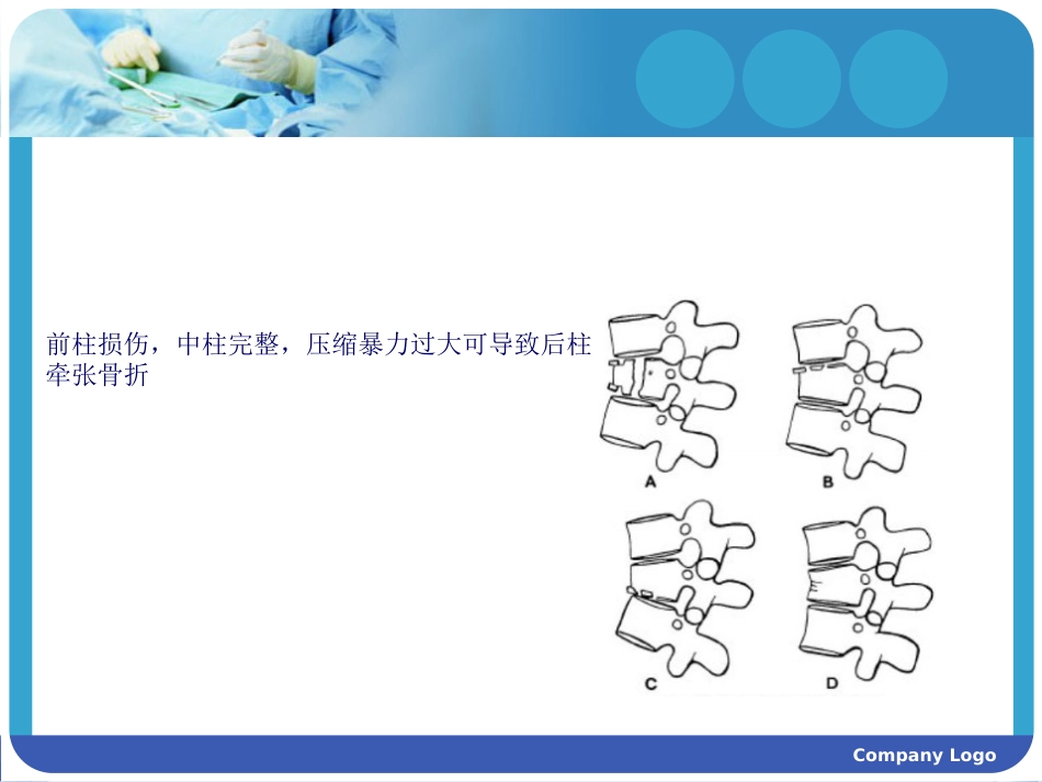脊柱骨折 常用分型及治疗原则_第5页