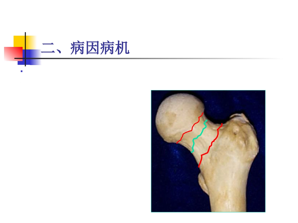 股骨颈 骨折概述_第6页