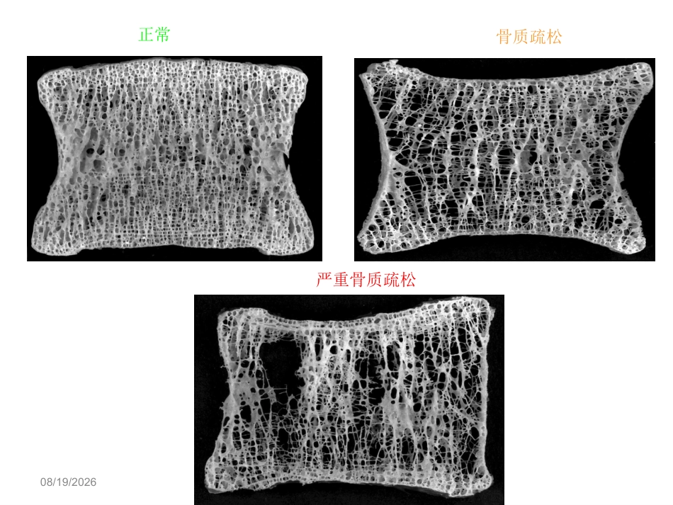 骨质疏松 的诊断与治疗_第3页