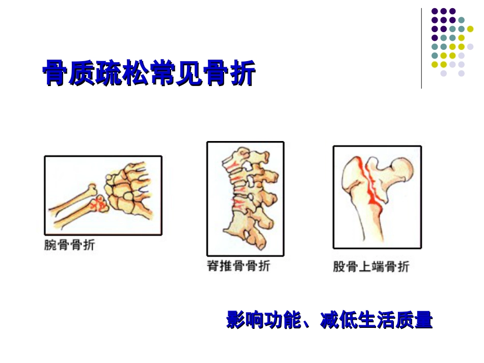 骨质 疏松症的诊治_第4页