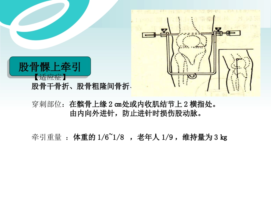 骨科 牵引术_第10页