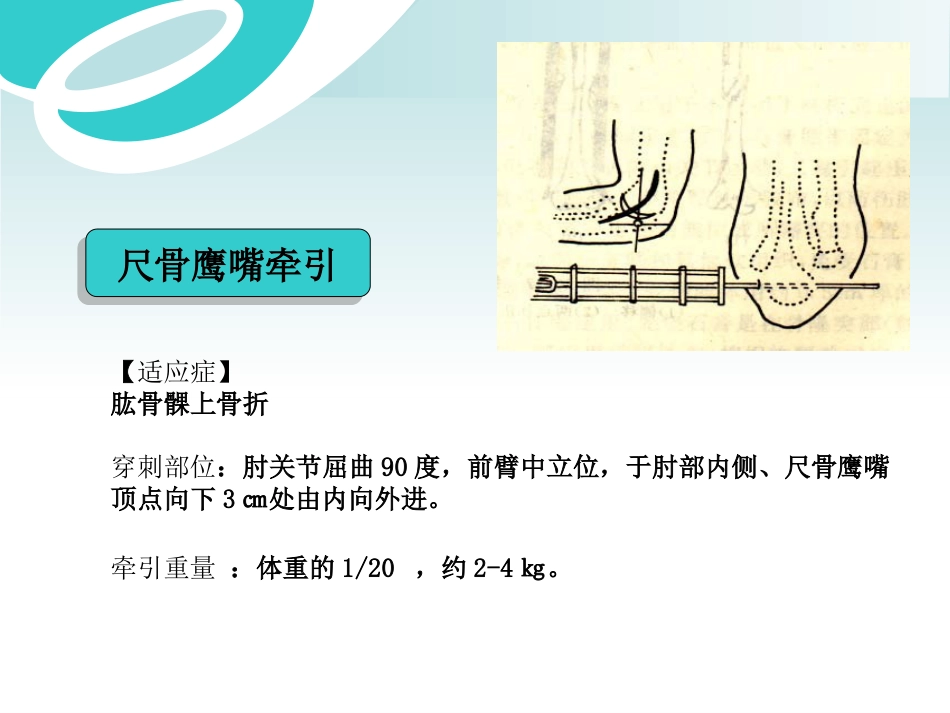骨科 牵引术_第14页