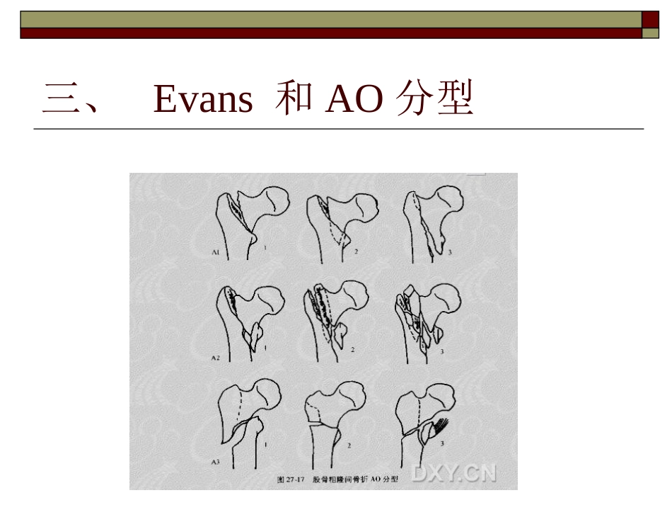 股骨粗隆间 骨折PPT_第11页