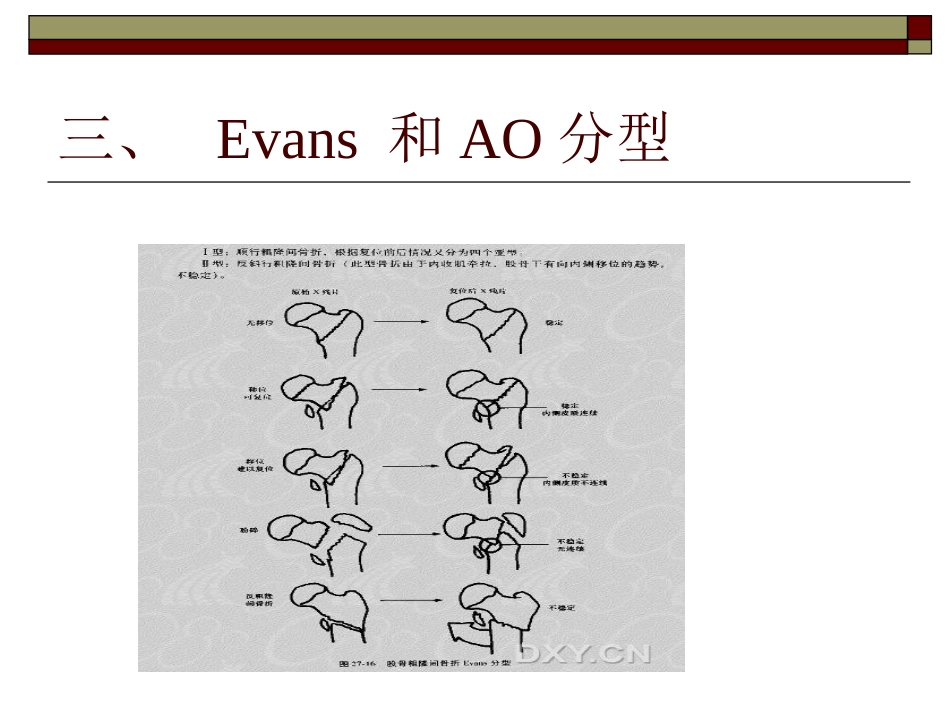 股骨粗隆间 骨折PPT_第9页