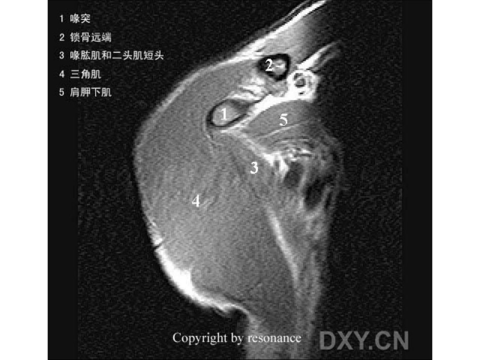 肩关节 正常MRI解剖图谱_第1页