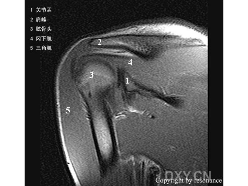 肩关节 正常MRI解剖图谱_第11页