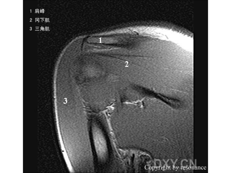 肩关节 正常MRI解剖图谱_第12页
