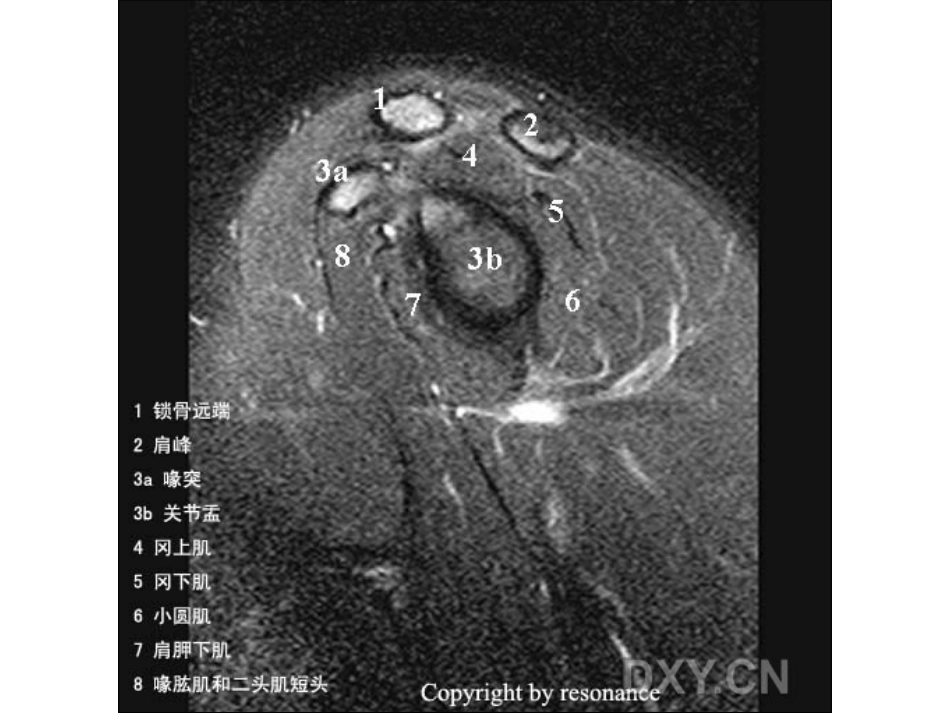 肩关节 正常MRI解剖图谱_第15页
