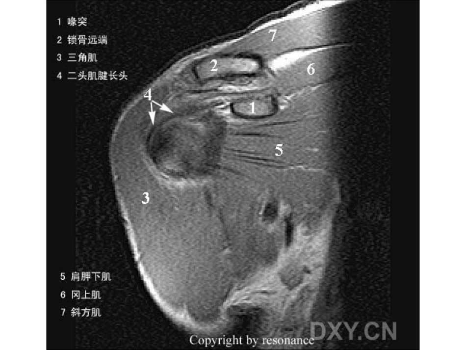 肩关节 正常MRI解剖图谱_第4页