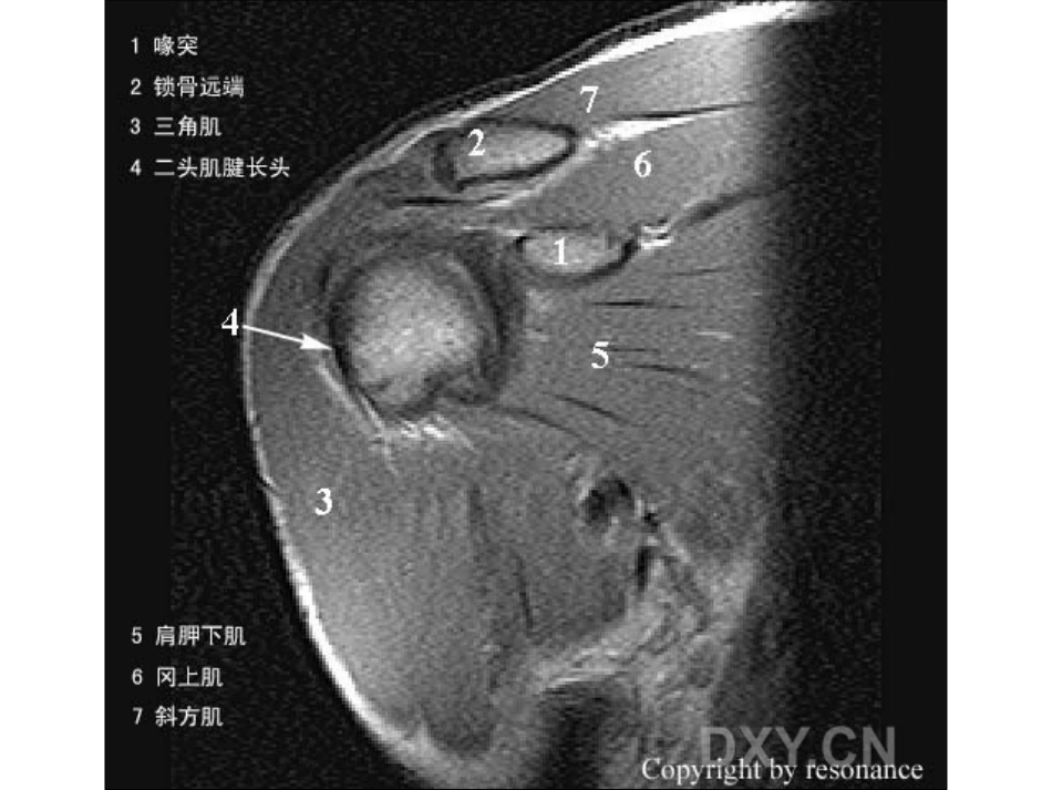 肩关节 正常MRI解剖图谱_第5页