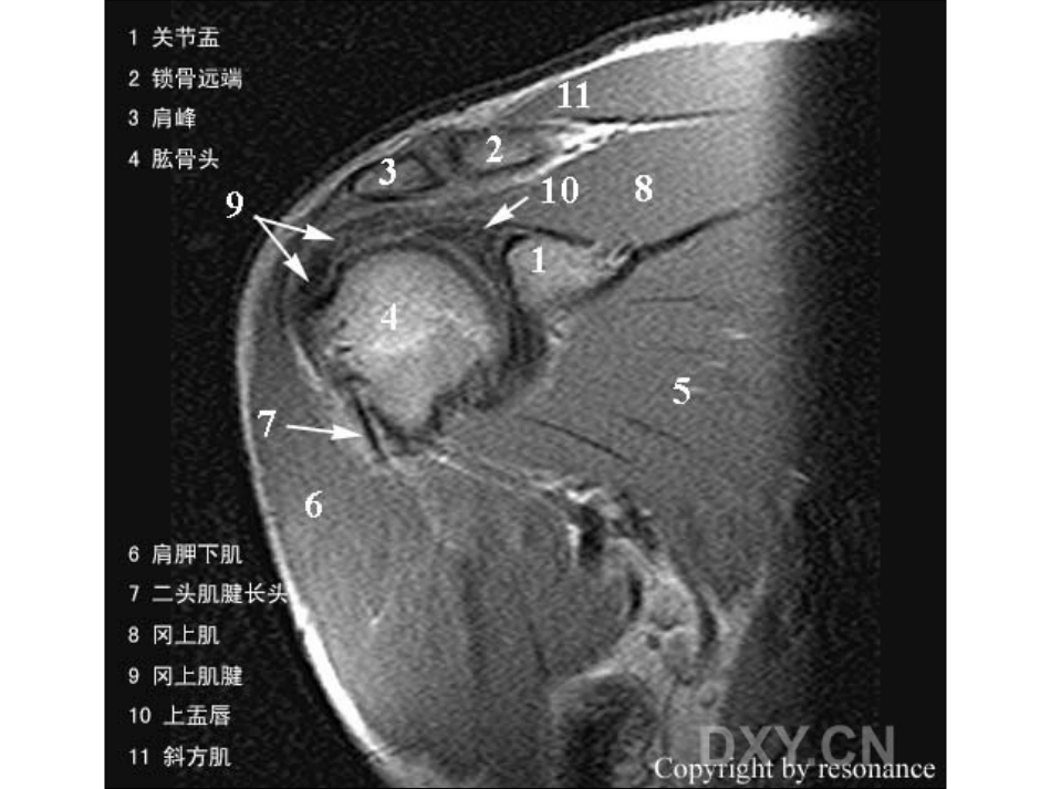 肩关节 正常MRI解剖图谱_第6页