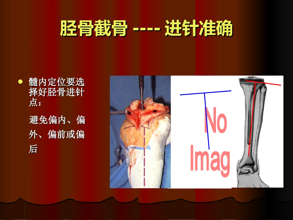 TKA 中软组织平衡的原则_第10页