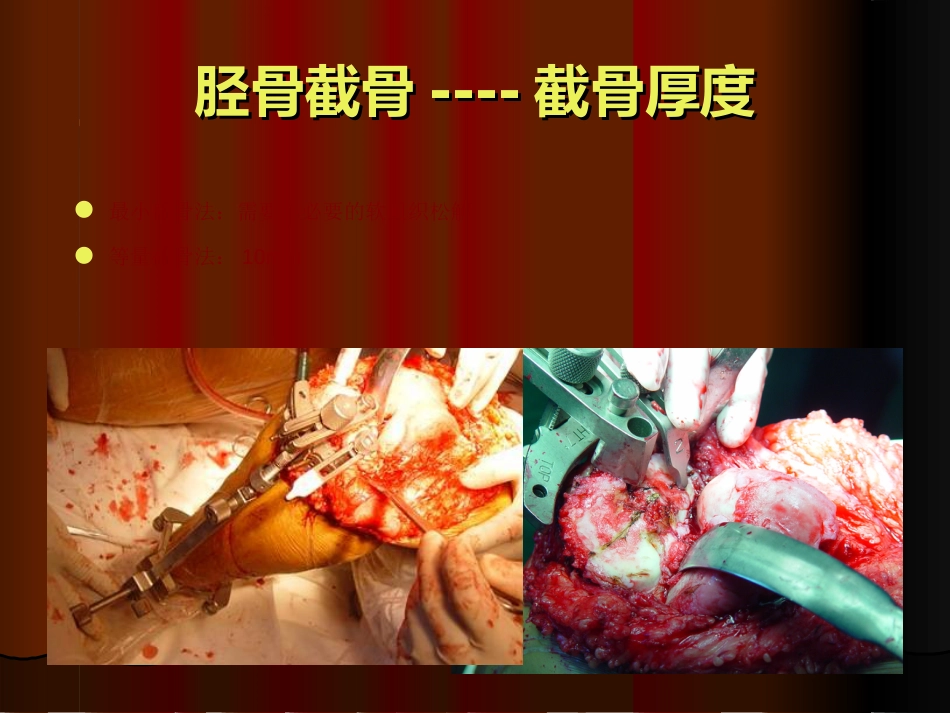 TKA 中软组织平衡的原则_第14页