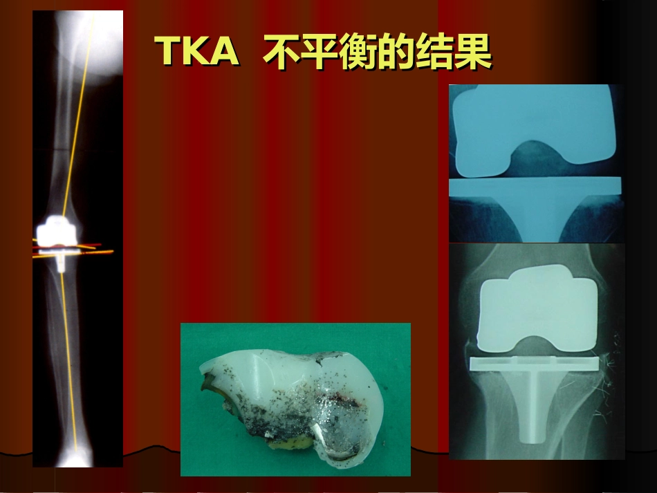 TKA 中软组织平衡的原则_第2页