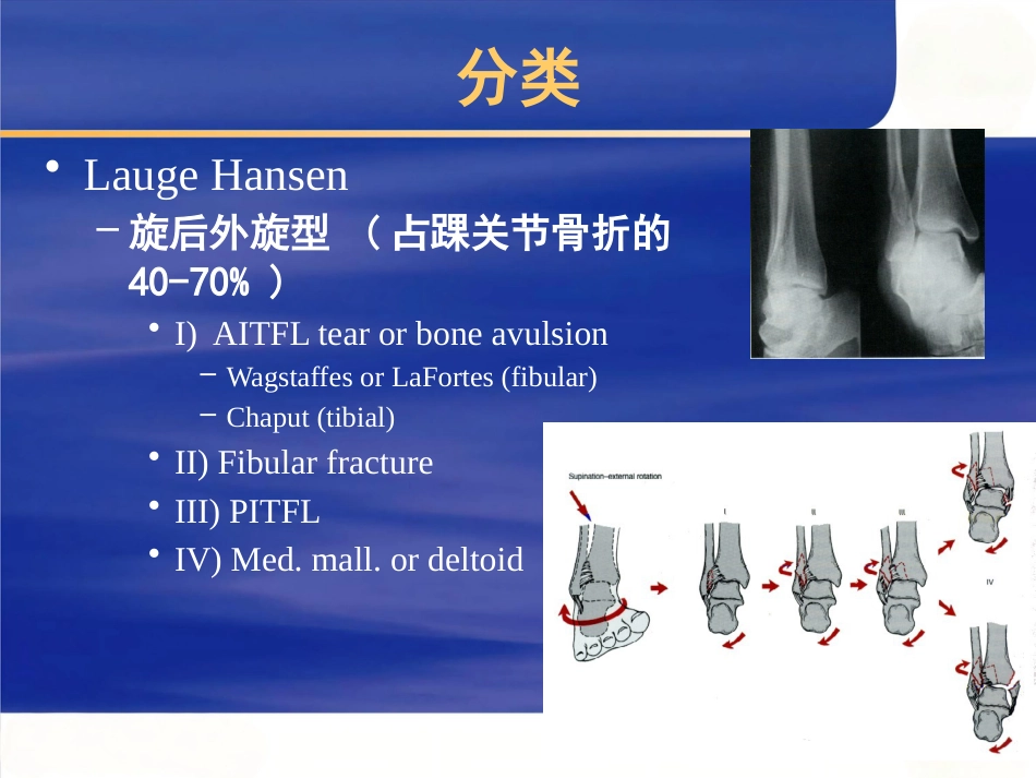 踝关节 骨折的治疗_第11页