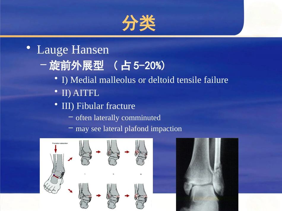 踝关节 骨折的治疗_第12页