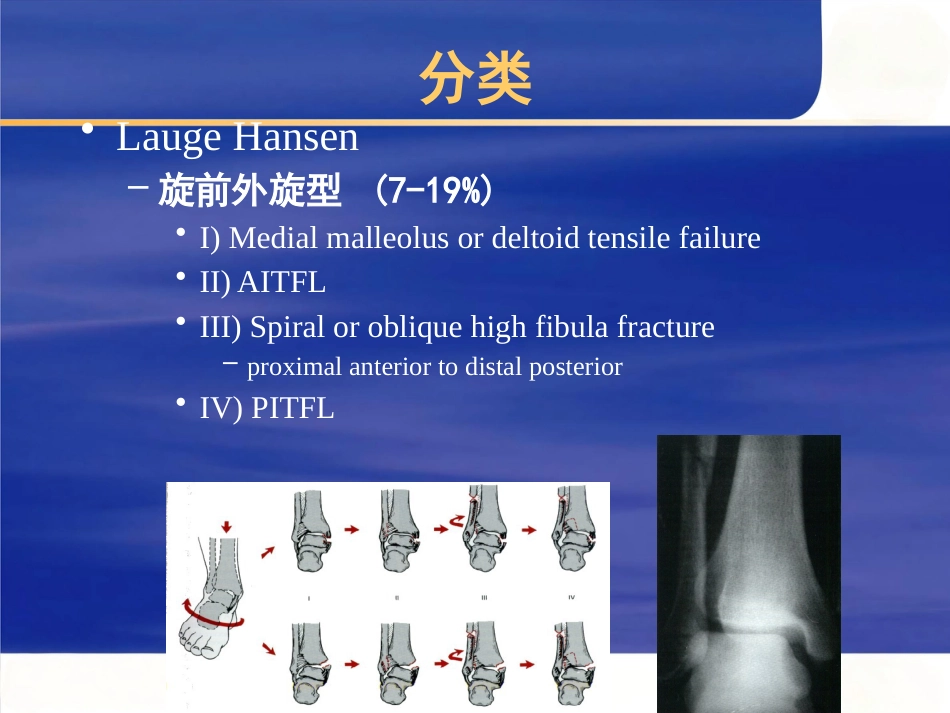 踝关节 骨折的治疗_第13页