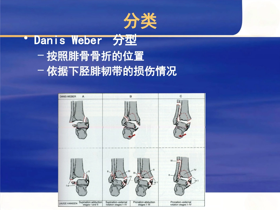 踝关节 骨折的治疗_第14页