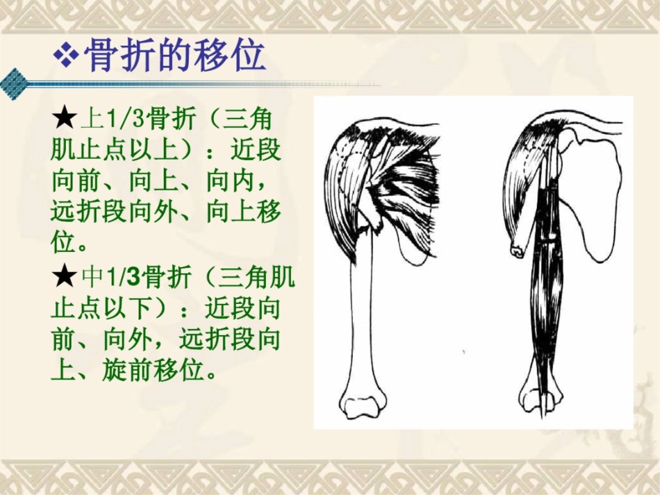 肱骨干骨折课件_第5页