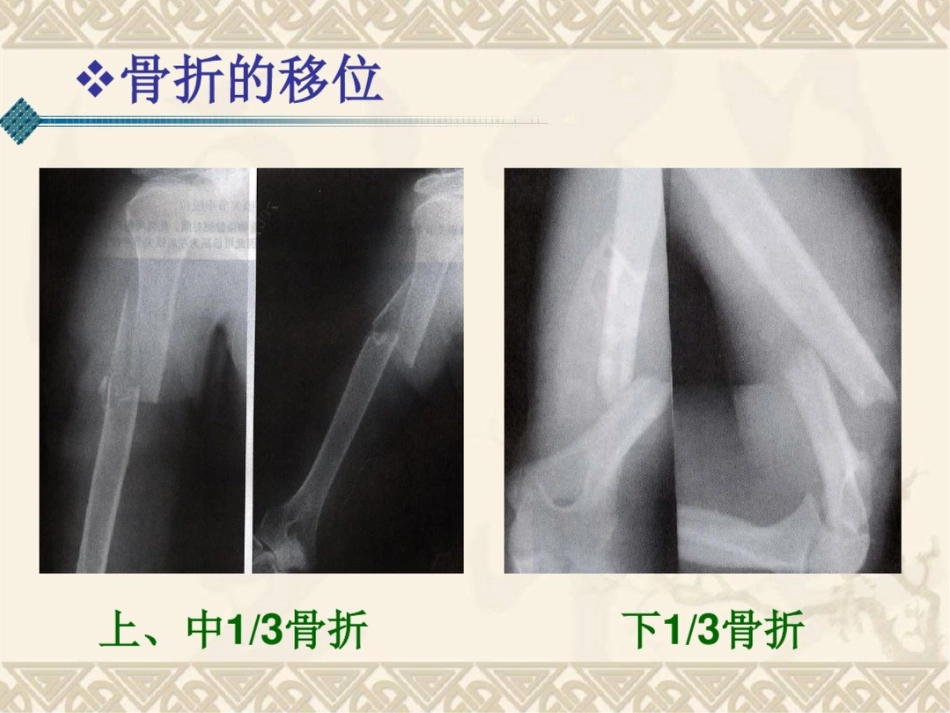 肱骨干骨折课件_第7页