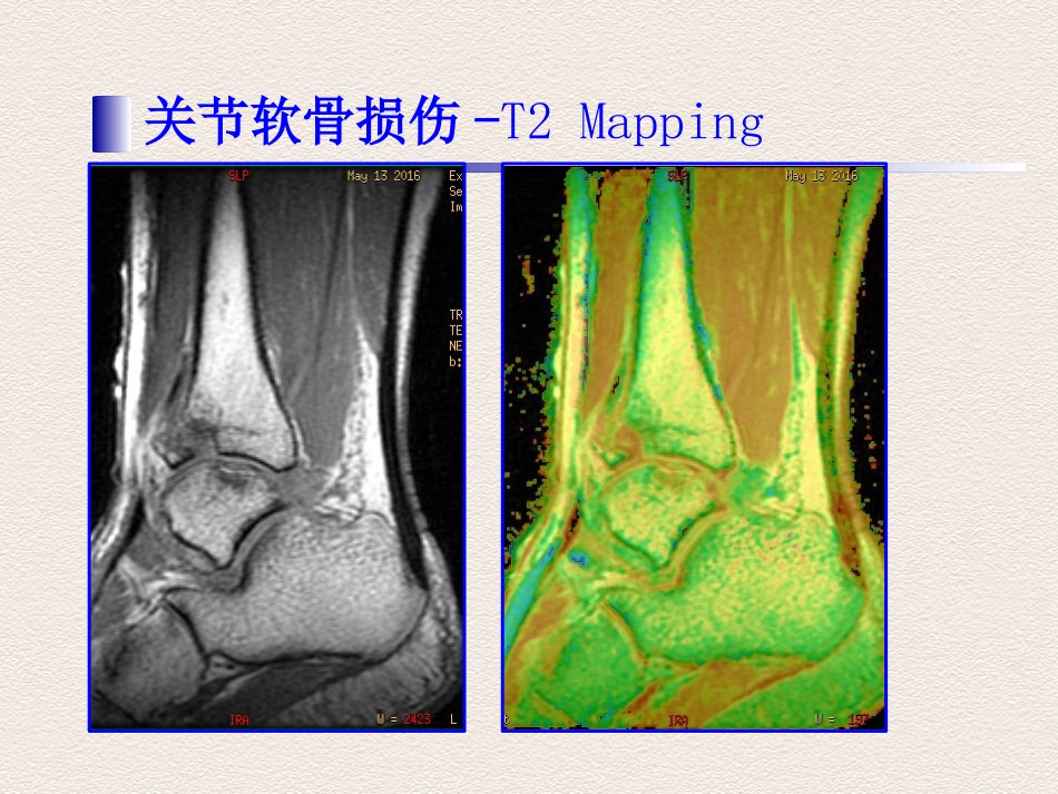 踝关节 运动损伤MR诊断价值_第10页