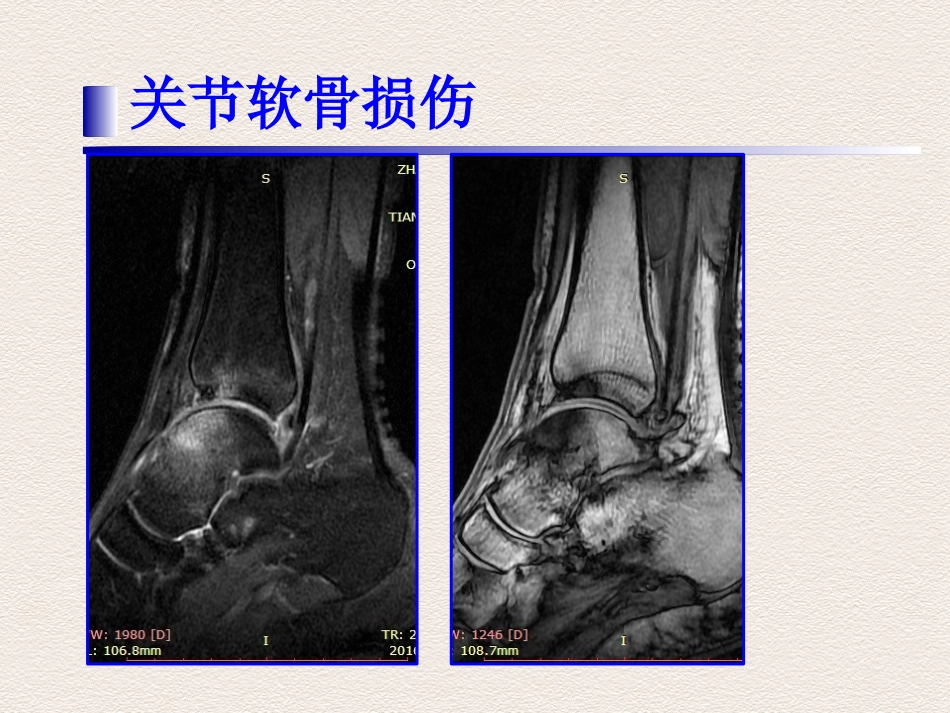 踝关节 运动损伤MR诊断价值_第5页
