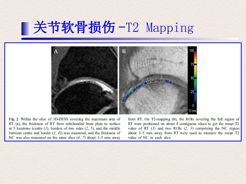 踝关节 运动损伤MR诊断价值_第9页