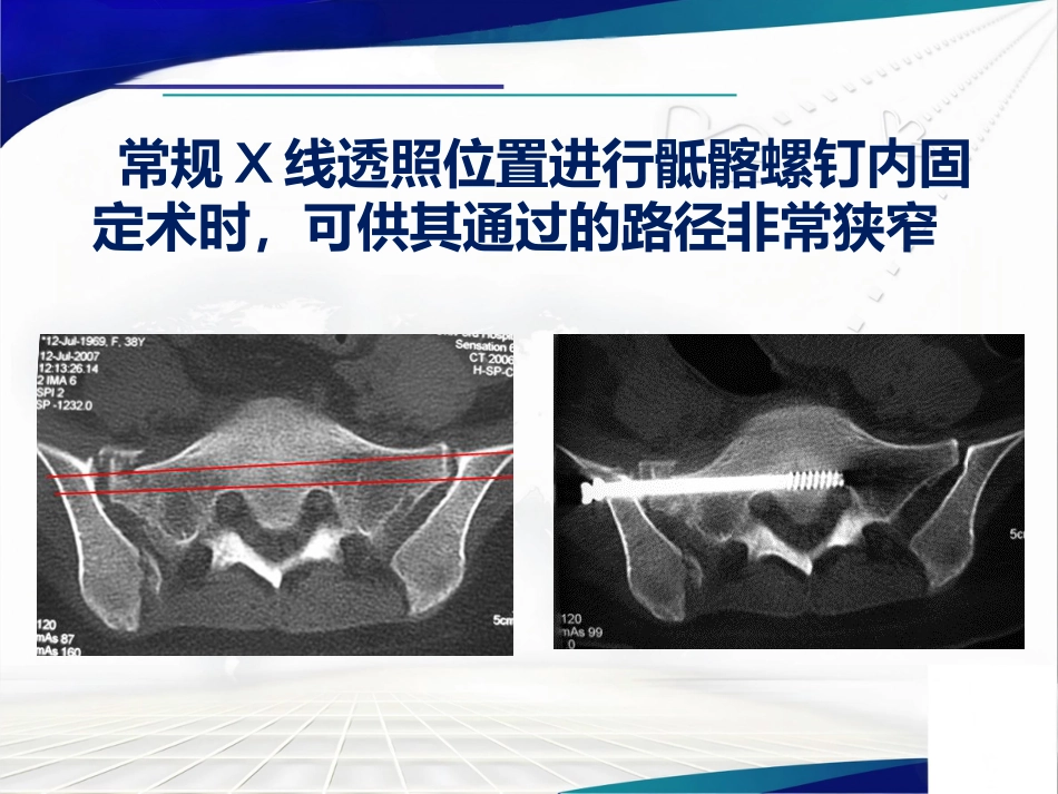 骨盆 髋臼骨折的微创治疗_第13页