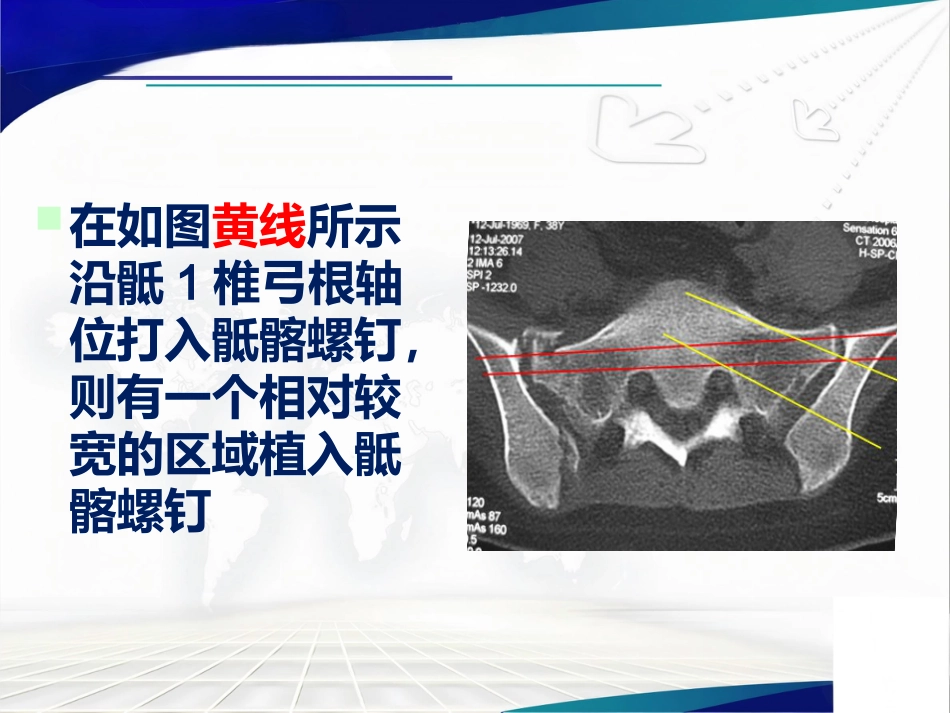 骨盆 髋臼骨折的微创治疗_第14页