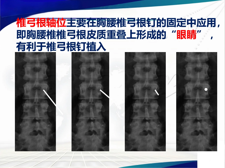 骨盆 髋臼骨折的微创治疗_第15页