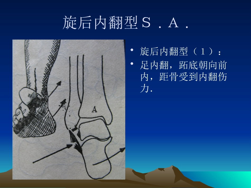 踝关节骨折分型1_第11页