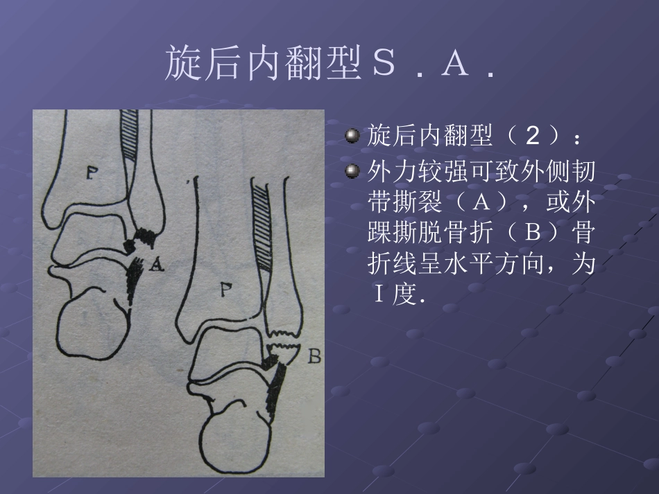 踝关节骨折分型1_第12页