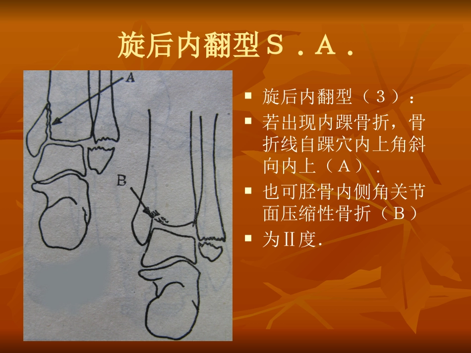 踝关节骨折分型1_第13页