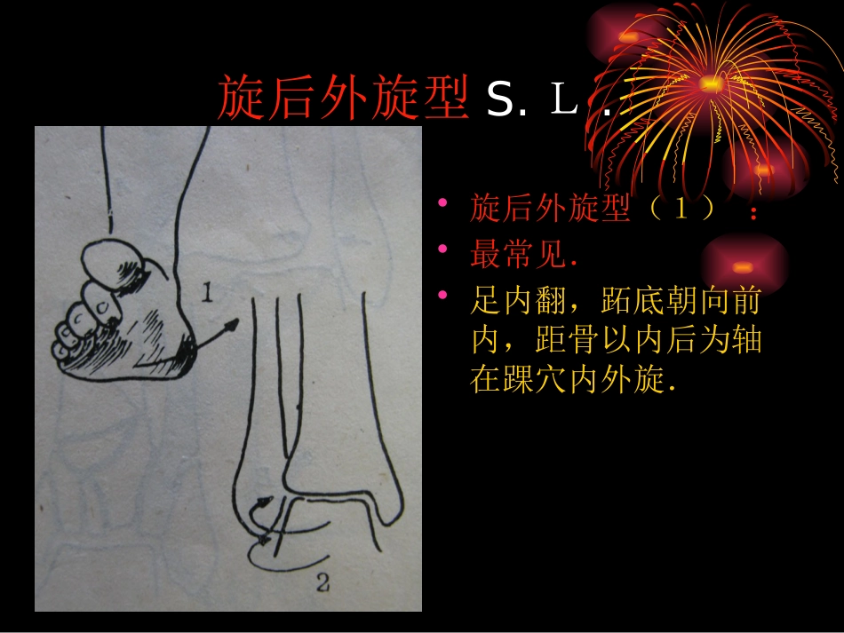 踝关节骨折分型1_第14页