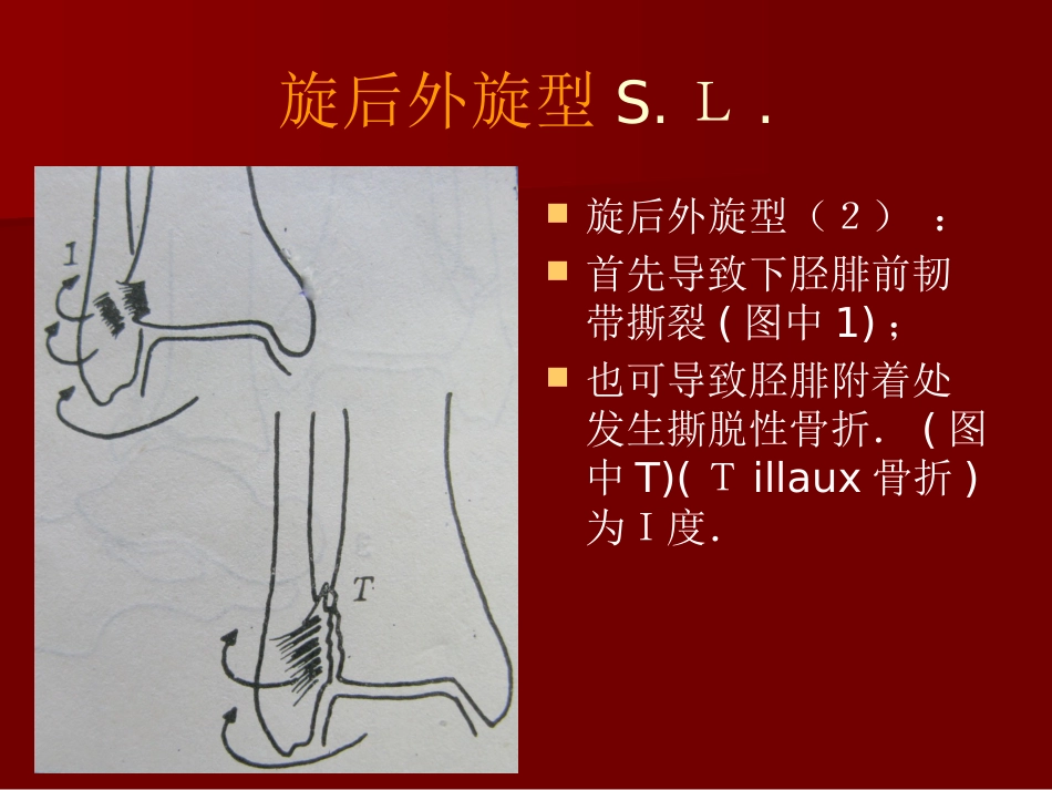 踝关节骨折分型1_第15页