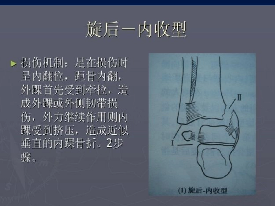 踝关节 骨折的分型2_第12页