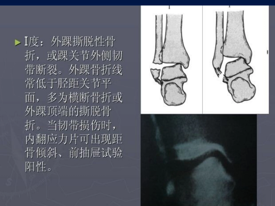 踝关节 骨折的分型2_第13页