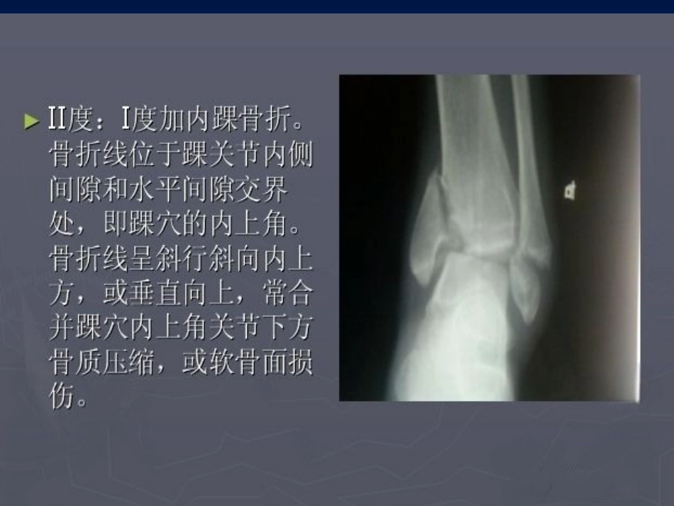 踝关节 骨折的分型2_第14页