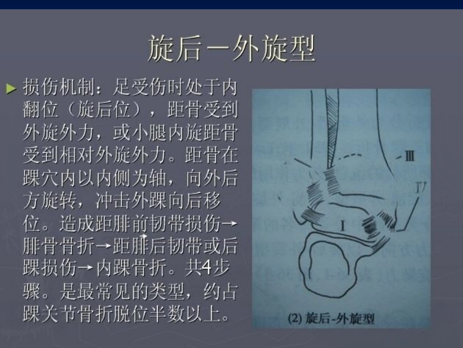 踝关节 骨折的分型2_第15页