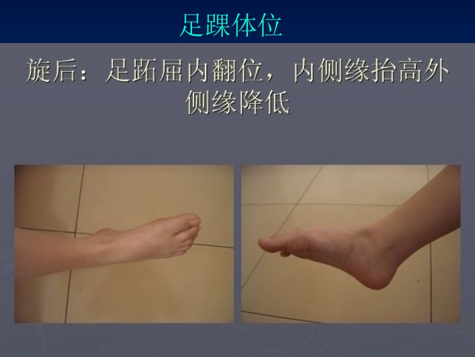 踝关节 骨折的分型2_第5页