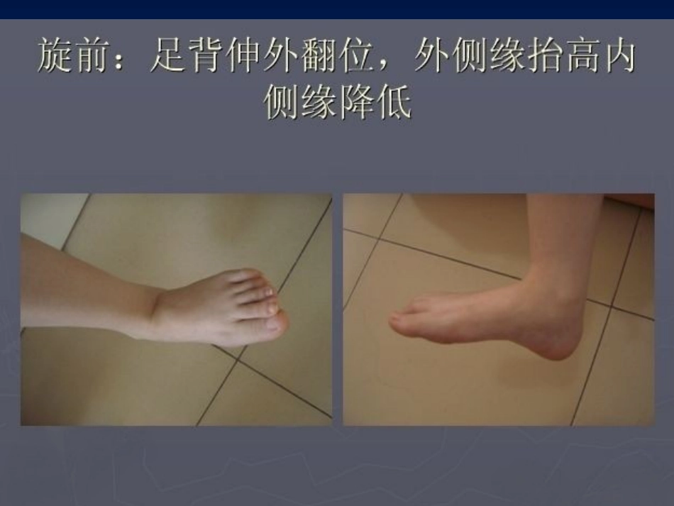 踝关节 骨折的分型2_第6页