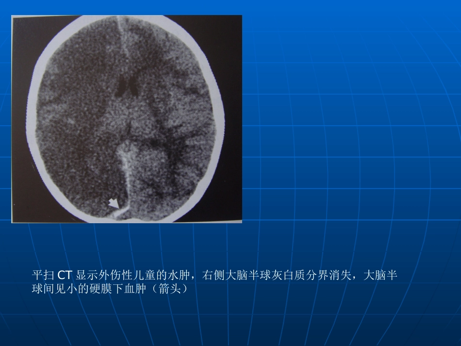 神经科-颅内压增高与脑疝_第7页